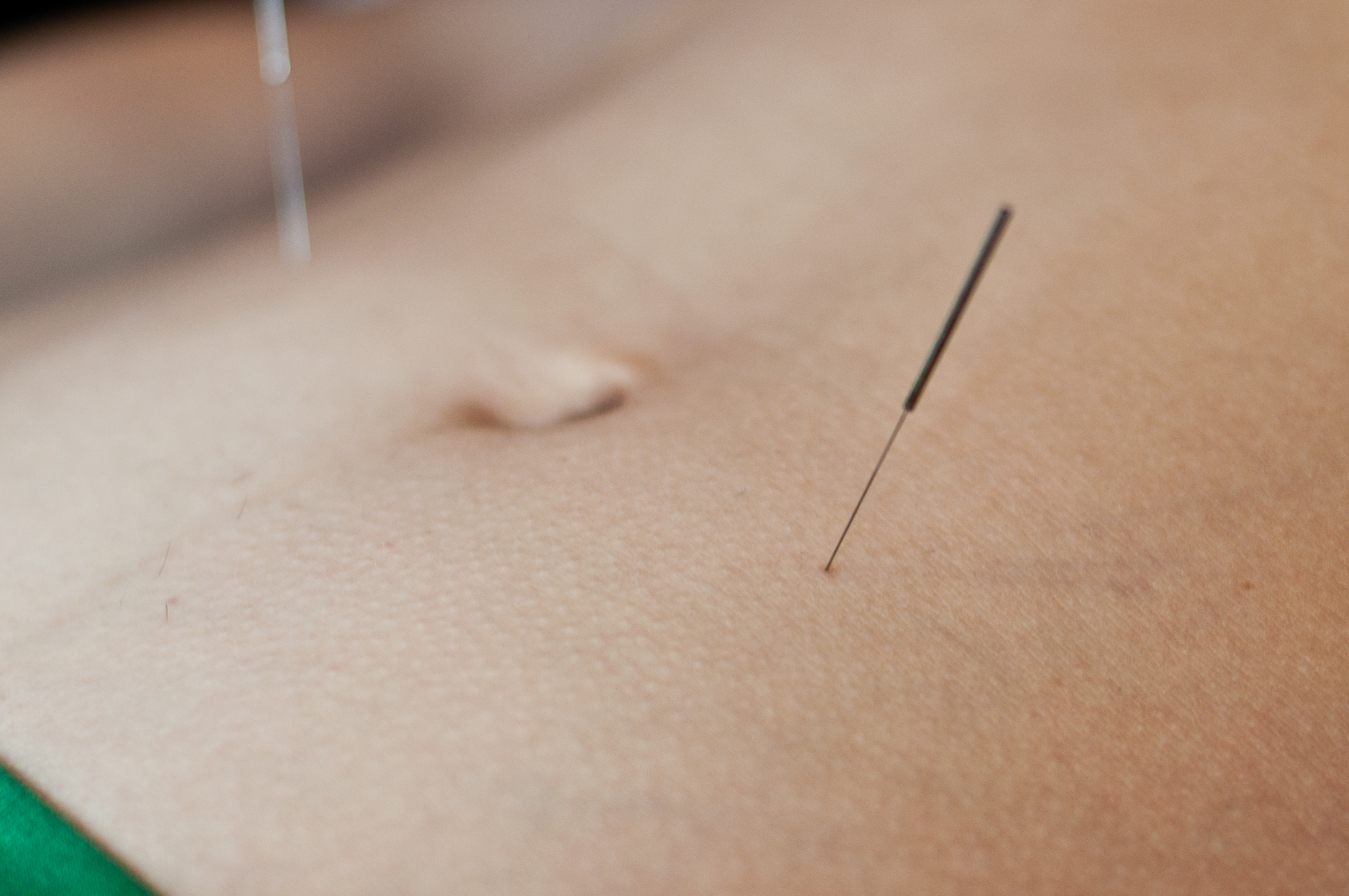 acupuncture
