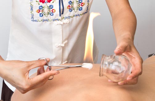 fire cupping Santa Barbara Herb Clinic