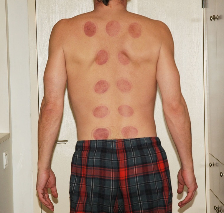fire cupping